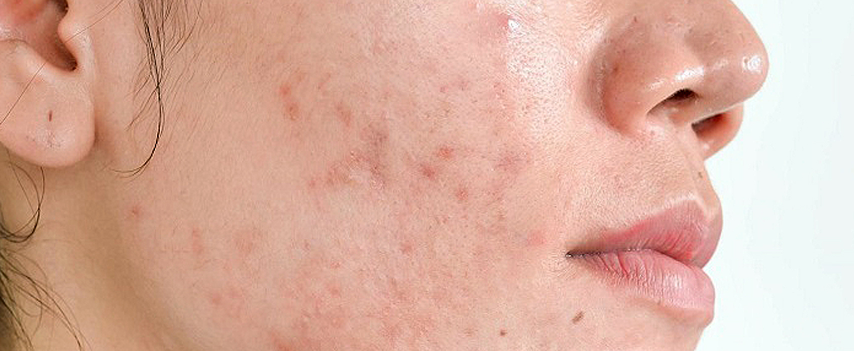 Get a Smooth Complexion with PICO Acne Scars Laser (PICOCARE)